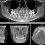 Cbct